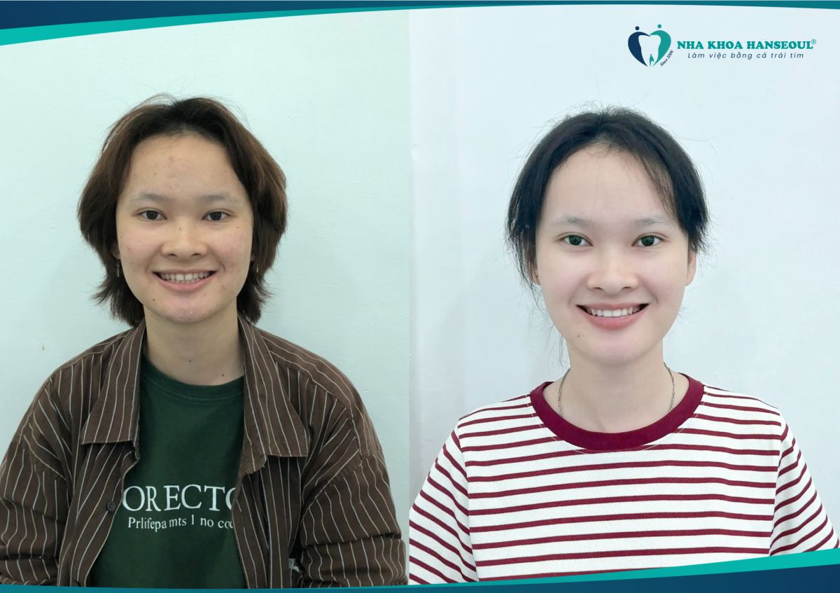 Sau 14 tháng niềng răng, không chỉ hàm răng thay đổi mà đường nét khuôn mặt cũng hài hòa hơn 