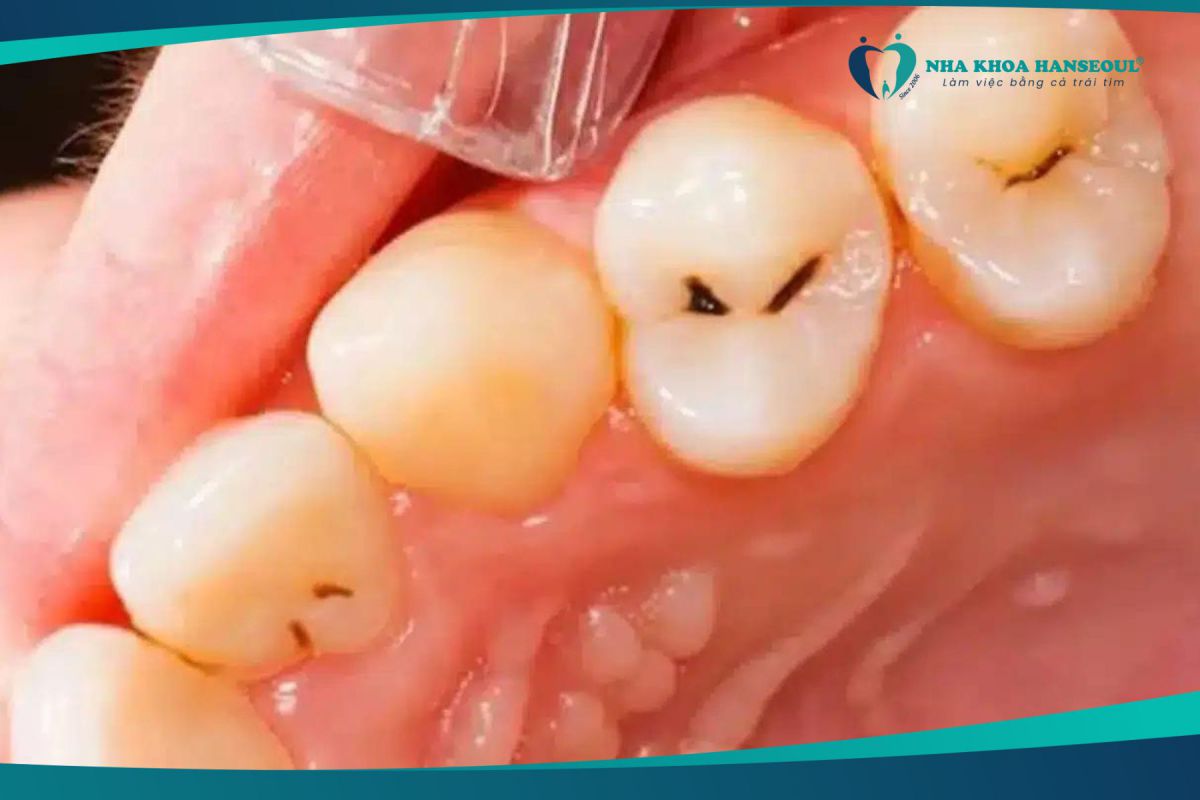 Tình trạng sâu men răng