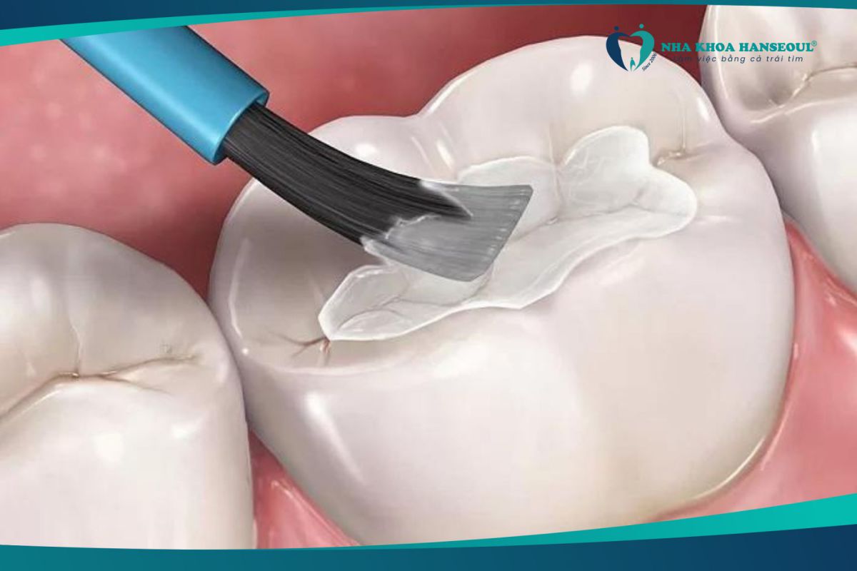 Phương pháp hàn trám răng