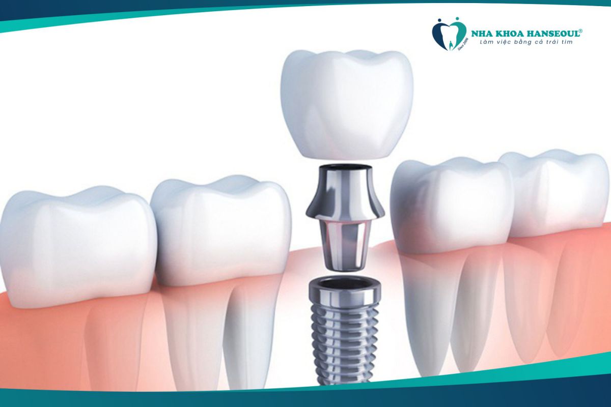 Phương pháp trồng Implant 