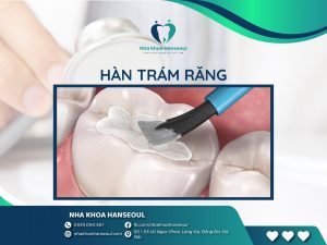 hàn răng