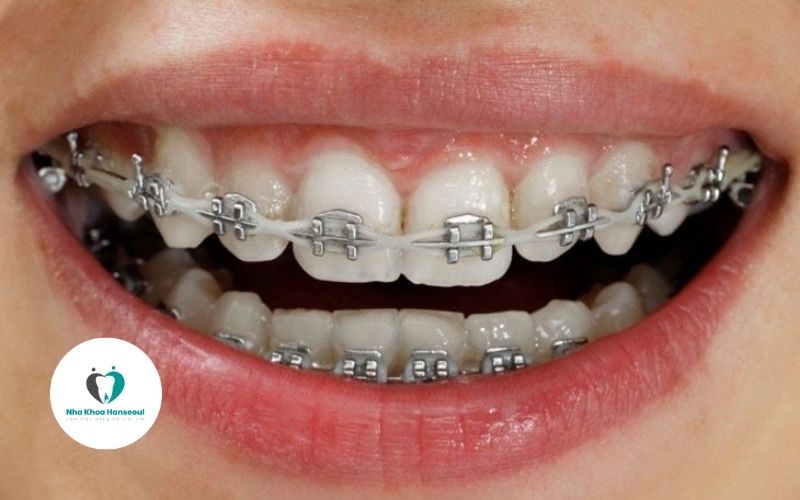 niềng răng mắc cài kim loại là gì