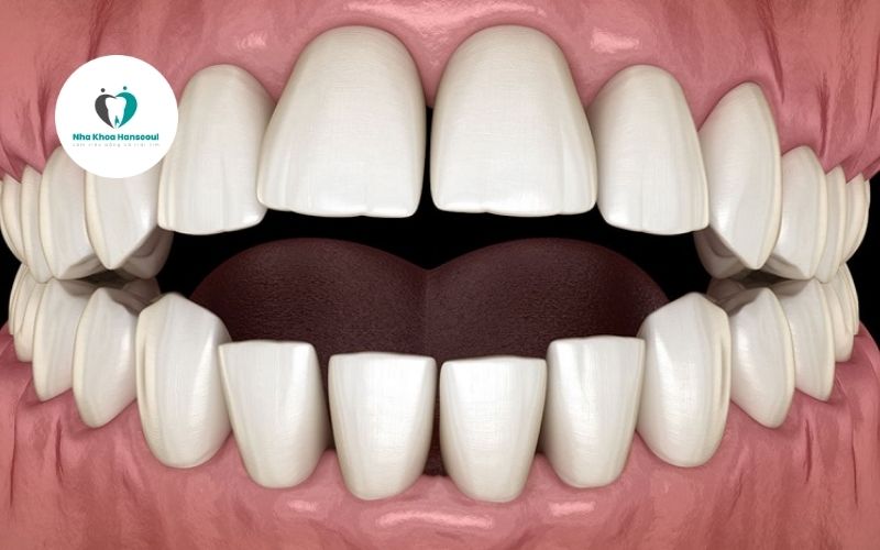 khớp cắn hở là gì