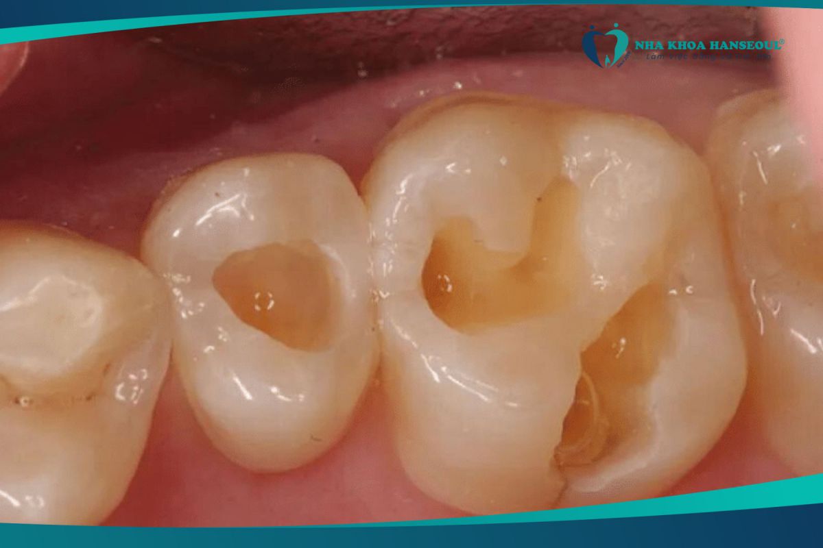 Tình trạng sâu ngà răng