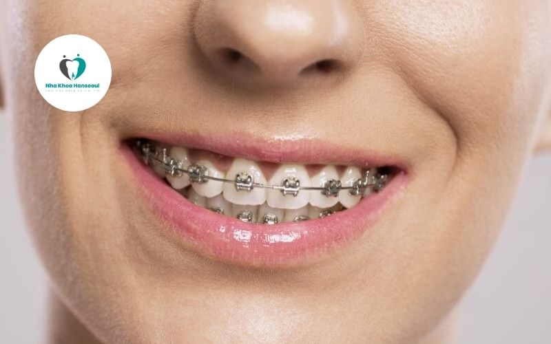 Lưu ý khi niềng răng mắc cài kim loại
