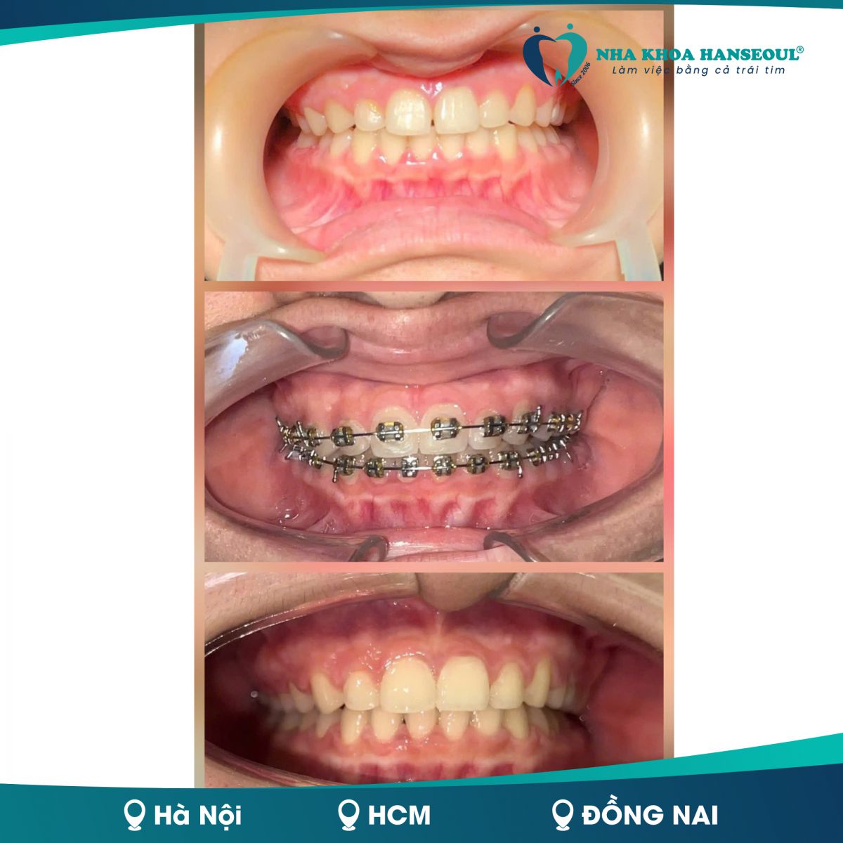 Tình trạng răng trước - trong - sau khi niềng của Bích Thảo 