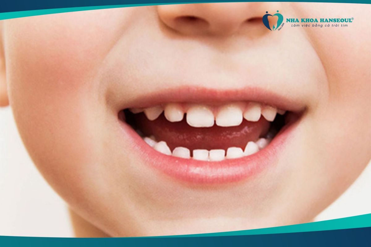 Phòng ngừa sâu răng cho trẻ 7 tuổi mà cha mẹ cần biết