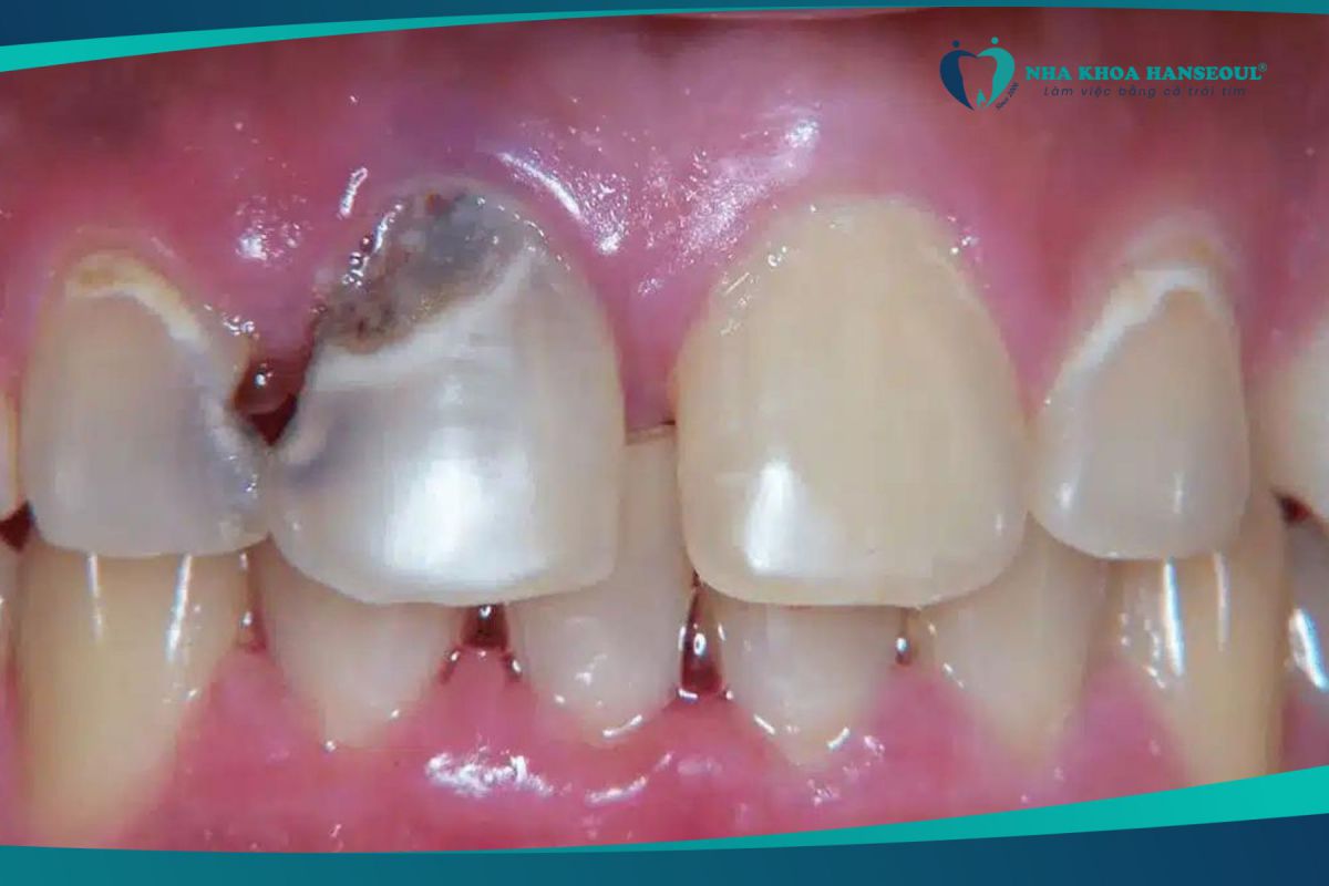 Sâu răng gây mất thẩm mỹ