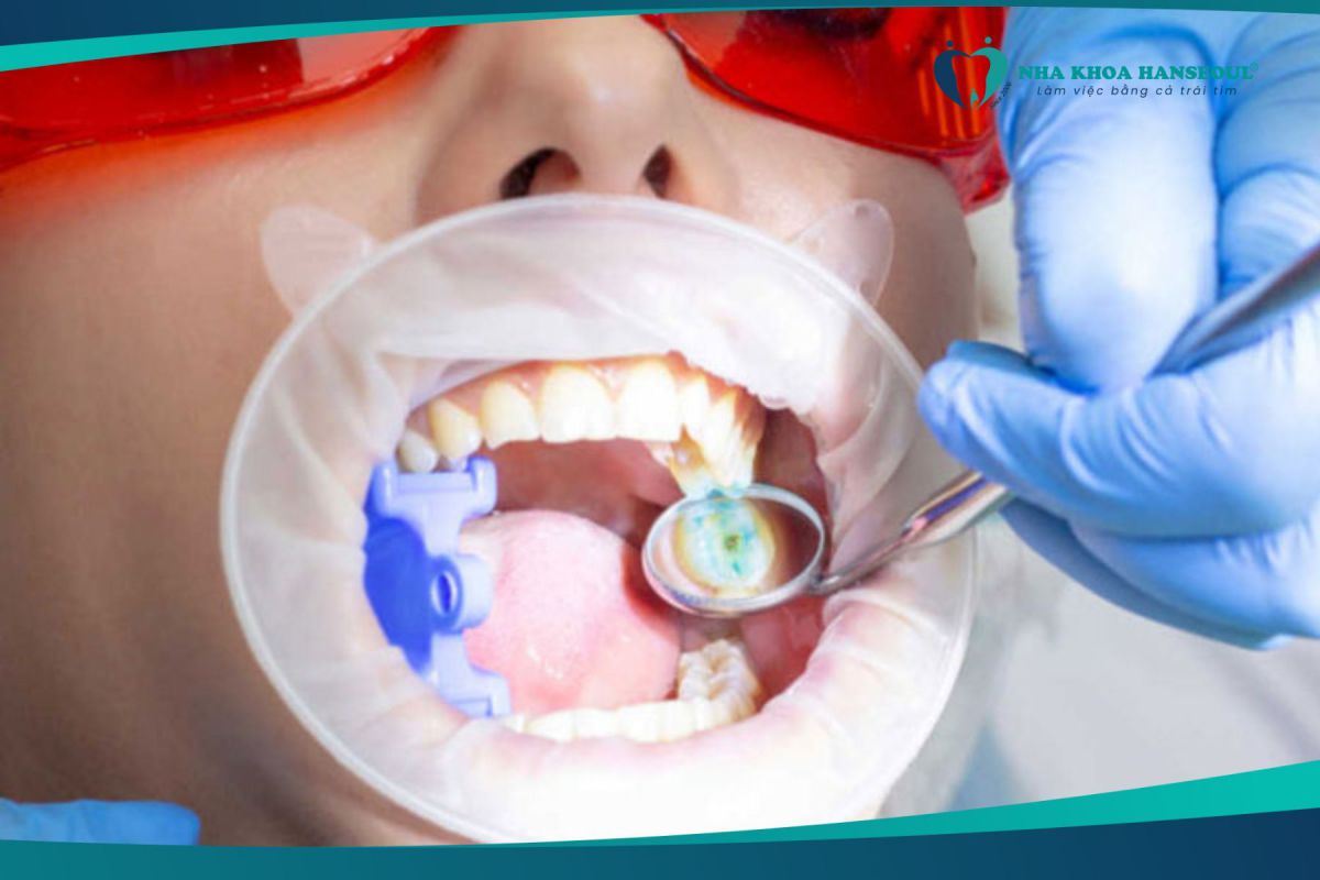 Lấy vôi răng định kỳ