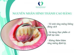 lấy cao răng giúp răng trắng sạch hơn