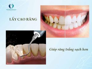lấy cao răng giúp răng khỏe mạnh hơn