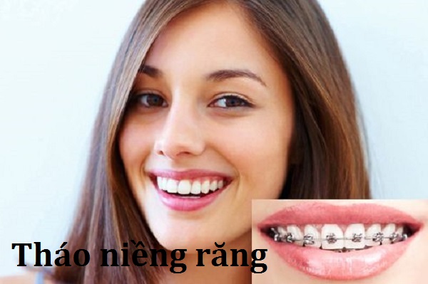 Bao lâu được tháo niềng răng Bao lâu được tháo niềng răng