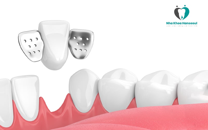 Cầu răng sứ cánh dán