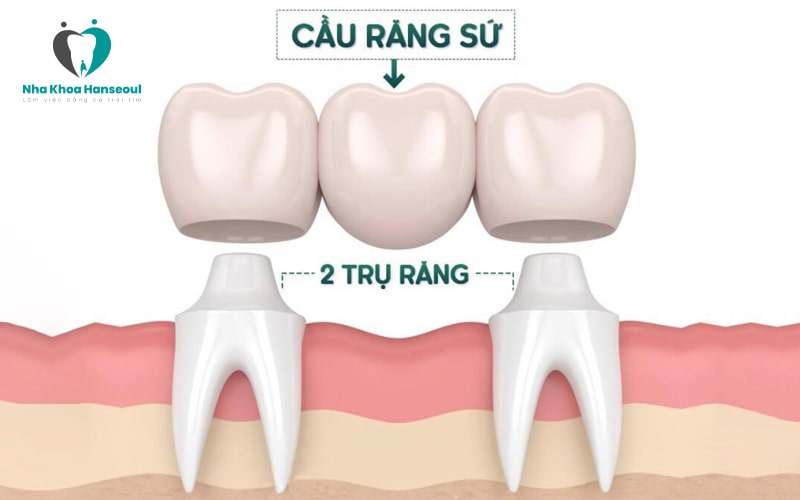 Cầu răng sứ