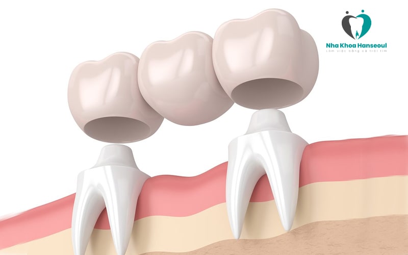 Cầu răng thông thường