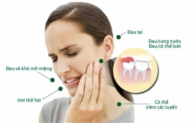 Đau răng do mọc răng khôn Đau răng do mọc răng khôn