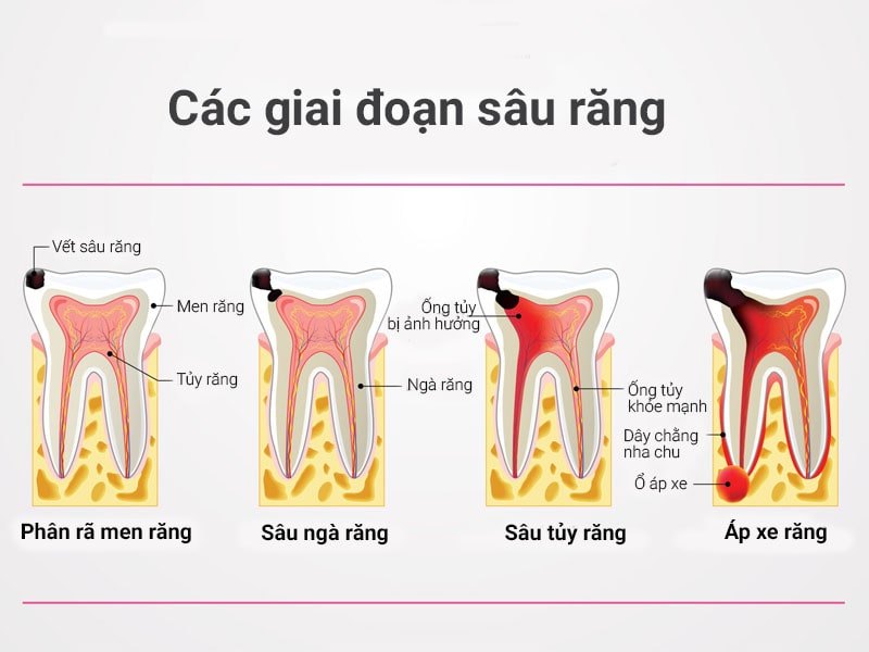 Các giai đoạn sâu răng