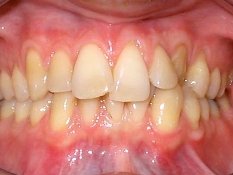 Hàm răng cần niềng