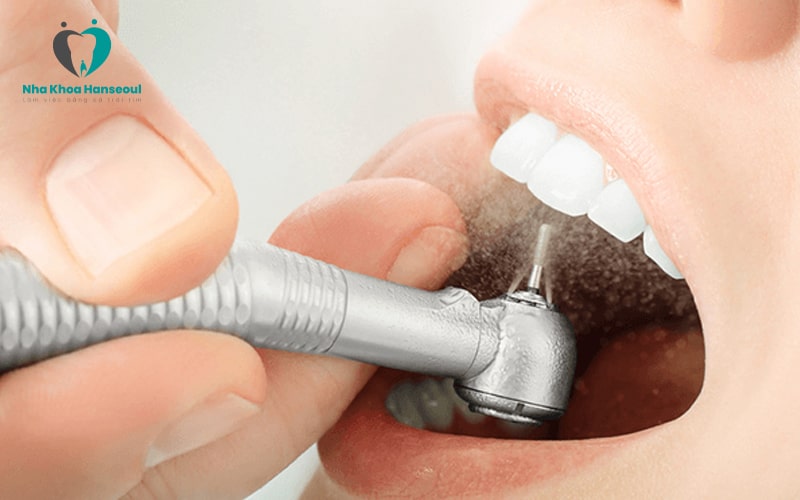 Lấy cao răng định kỳ