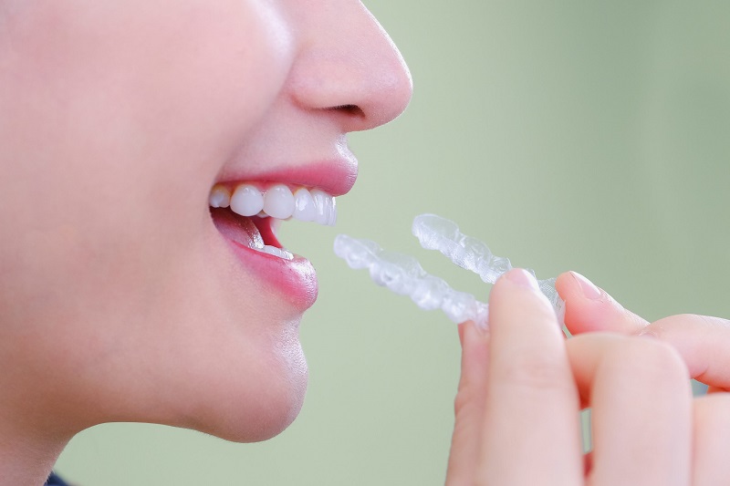 Niềng răng Invisalign Niềng răng Invisalign