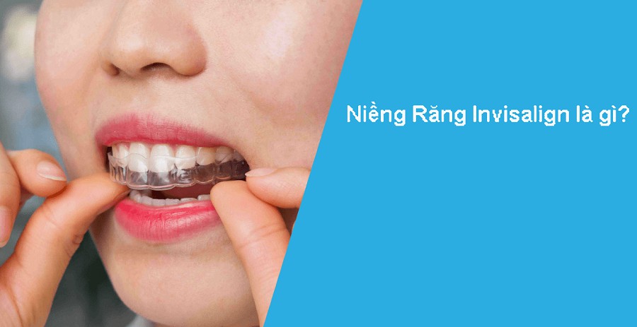 Niềng răng invisalign là gì Niềng răng invisalign là gì