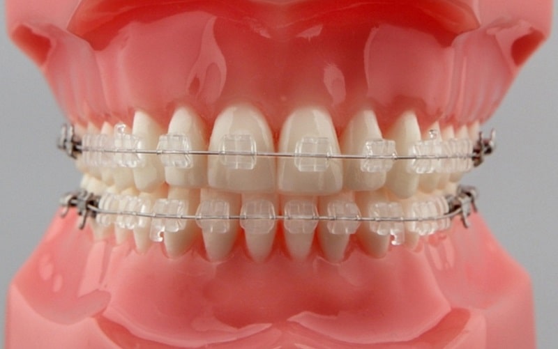 Niềng răng mắc cài sứ tự buộc