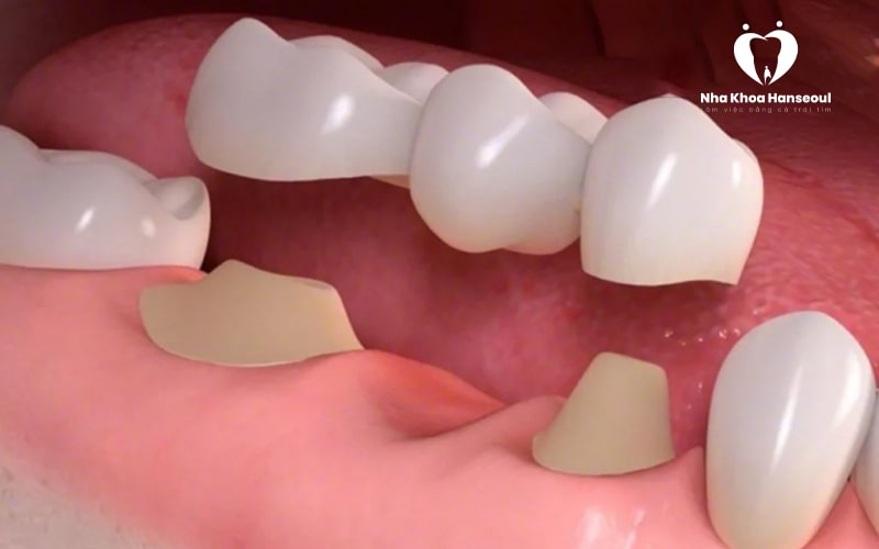 Phục hình răng bằng cầu răng sứ