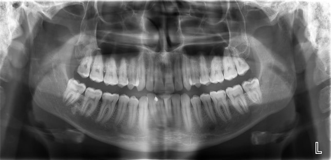 Răng khôn mọc thẳng chuẩn