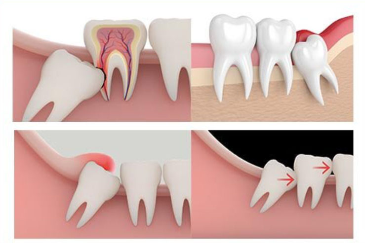 Răng khôn xô lệch hàm