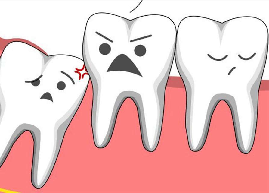 Răng khôn xô lệch răng bên cạnh