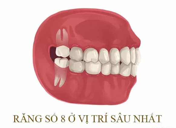 Răng số 8 là răng gì