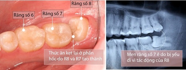 Răng số 8 chèn rang số 7