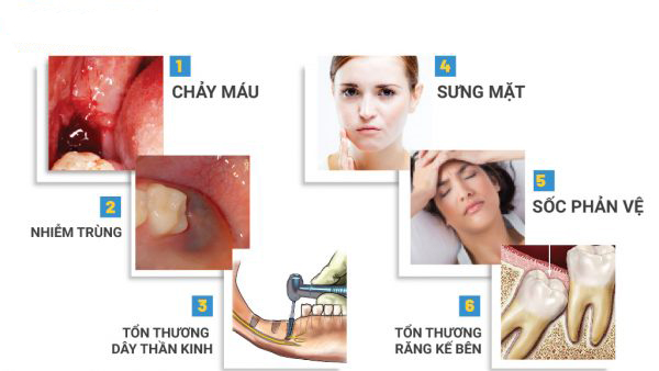 Sau khi nhổ răng khôn