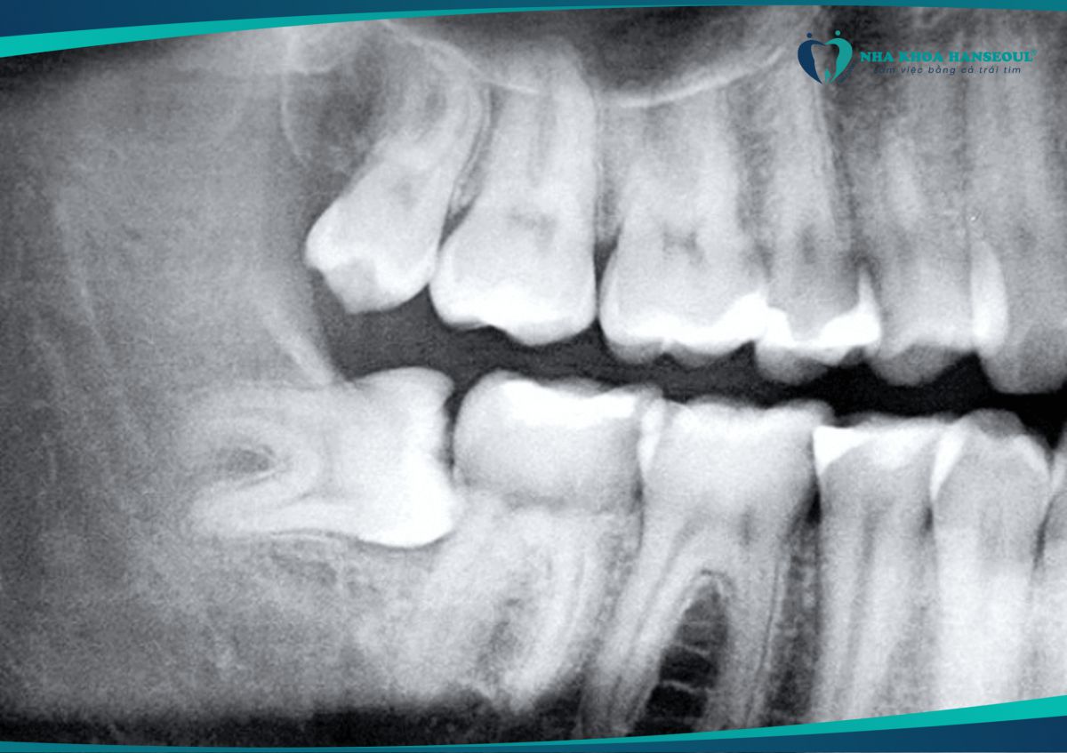 Răng khôn mọc lệch cần được nhổ để tránh gây các biến chứng nguy hiểm