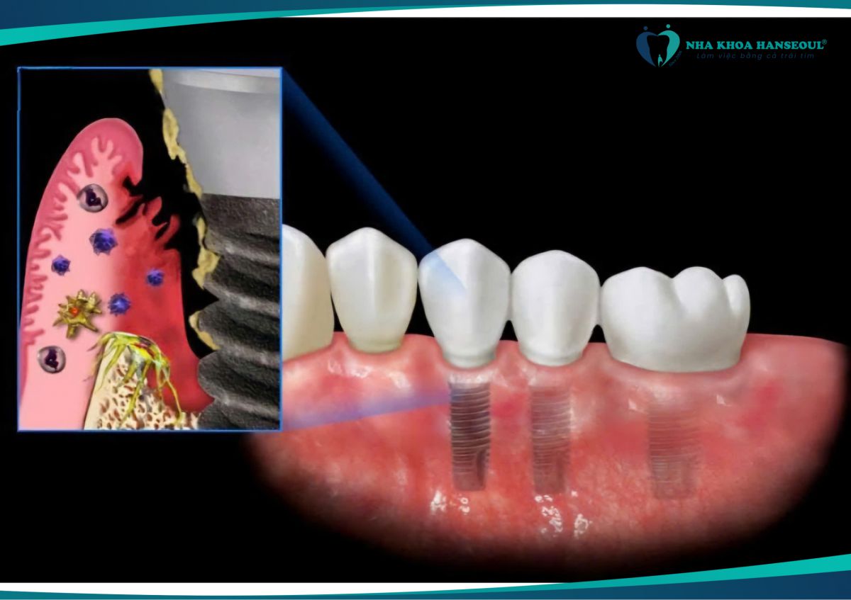 Nhiễm trùng vùng cấy implant