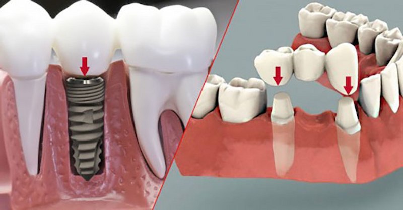 Trồng răng sứ trên trụ implant Trồng răng sứ trên trụ implant