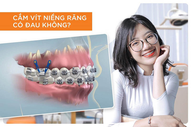 Trường hợp bắt vít niềng răng Trường hợp bắt vít niềng răng