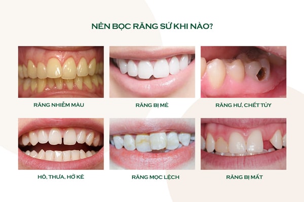 Trường hợp nên bọc răng sứ
