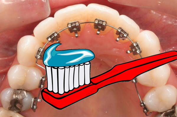 Vệ sinh niềng răng mặt trong Vệ sinh niềng răng mặt trong