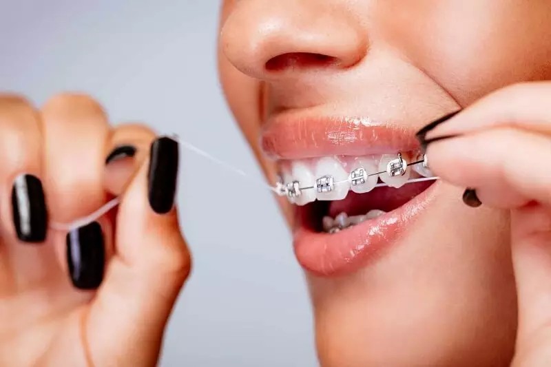 Vệ sinh răng miệng khi niềng Vệ sinh răng miệng khi niềng