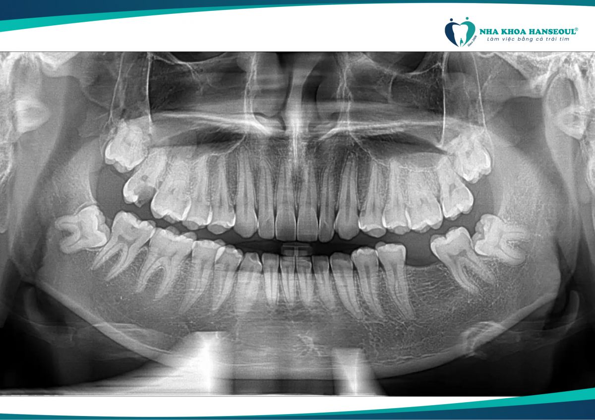 Răng khôn mọc gây ra những cơn đau dữ dội cho anh Trọng