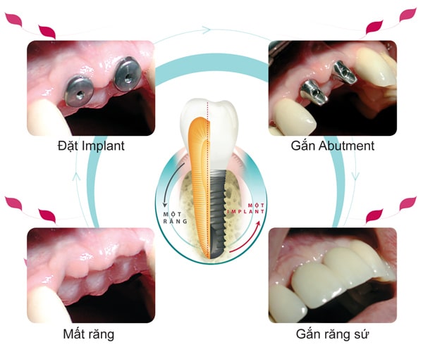quy-trinh-trong-rang-implant