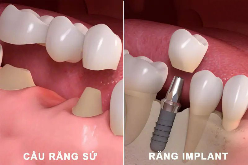 Cầu răng sứ và trồng răng implant Cầu răng sứ và trồng răng implant