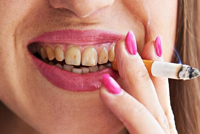 Hút thuốc lá khiến răng bị ố vàng Hút thuốc lá khiến răng bị ố vàng