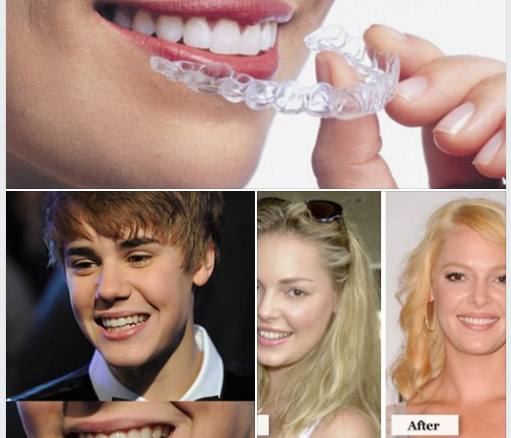 Invisalign cùng người nổi tiếng Invisalign cùng người nổi tiếng
