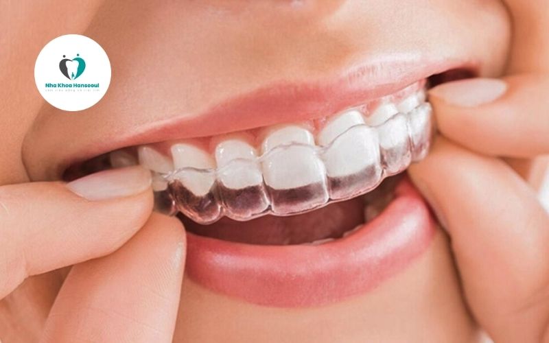 niềng răng invisalign