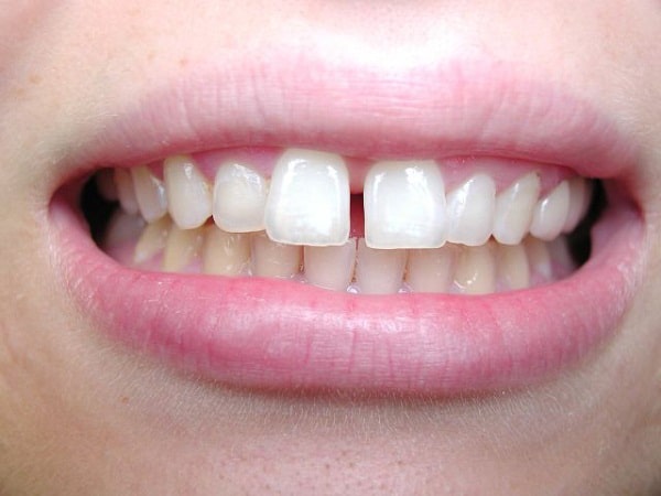 Niềng răng thưa 1 hàm Niềng răng thưa 1 hàm