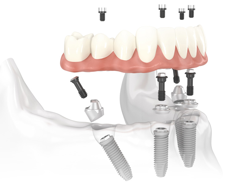 Quy trình cấy ghép Implant All On 4