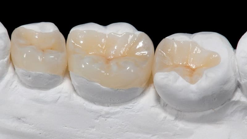 Vật liệu trám Sứ