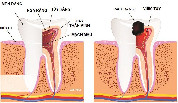 Bệnh viêm tủy răng Bệnh viêm tủy răng